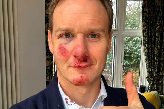 Dan Walker says he has no memory of the crash which left him bloody and bruised. Credit: Dan Walker