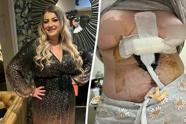 Sara Platt during happier times (L) and her right breast died and she contracted an anti-biotic resistant infection after a ’botched’ Turkish cosmetic surgery (R). (Sara Platt / SWNS)