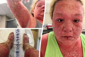 Woman's extreme allergic reaction to mosquito bite on holiday in the Caribbean 