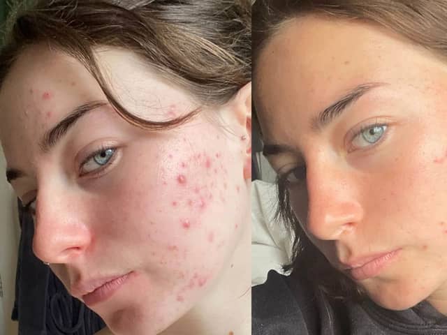 Fight breakouts with 47 Skin and the revolutionary skincare ingredient you’ve properly never heard of 