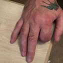 Bryan's finger was amputated below the knuckle
