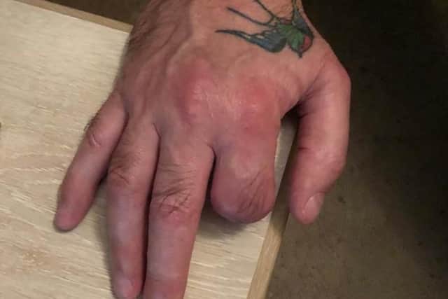 Bryan's finger was amputated below the knuckle