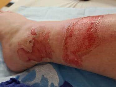 The 12-year-old's leg on Monday, two days after the incident. It is still being assessed by plastic surgeons for skin grafts