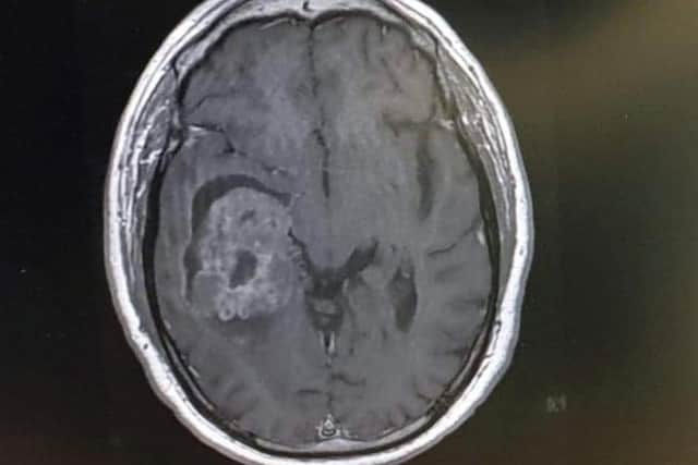 Matt's brain scan. Photo: Brain Tumour Research