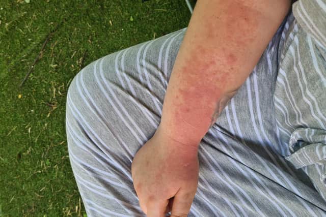 Heat reaction: Gemma's arm after being exposed to sunlight