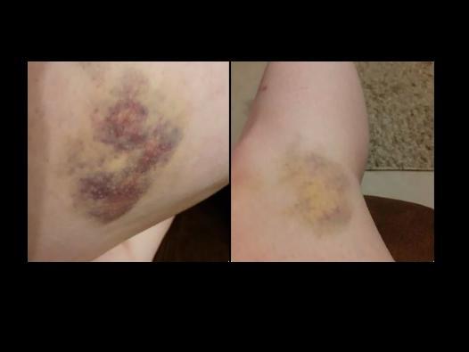 Louise suffered severe bruising