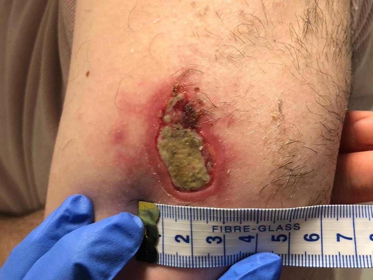 This is the damage a suspected SPIDER bite caused to Milton Keynes man