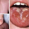 These are some of the scarlet fever symptoms to look out for. There have been 58 cases of the disease, caused by the Strep A bacteria, recorded in Sheffield since the end of September. Photo: NHS
