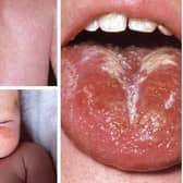 These are some of the scarlet fever symptoms to look out for. There have been 58 cases of the disease, caused by the Strep A bacteria, recorded in Sheffield since the end of September. Photo: NHS