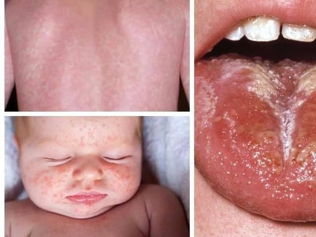 These are some of the scarlet fever symptoms to look out for. There have been 58 cases of the disease, caused by the Strep A bacteria, recorded in Sheffield since the end of September. Photo: NHS