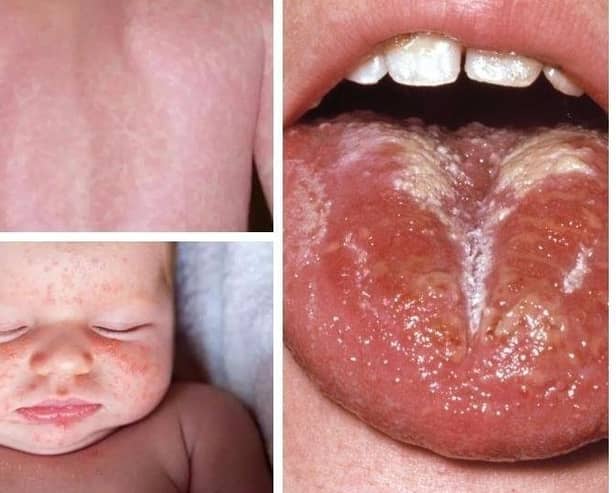 These are some of the scarlet fever symptoms to look out for. There have been 58 cases of the disease, caused by the Strep A bacteria, recorded in Sheffield since the end of September. Photo: NHS