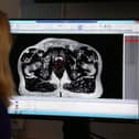 More men locally are being diagnosed with prostate cancer