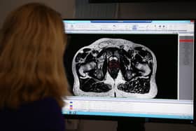 More men locally are being diagnosed with prostate cancer