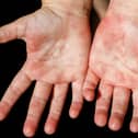 Symptoms of scarlet fever include a sandpapery skin rash