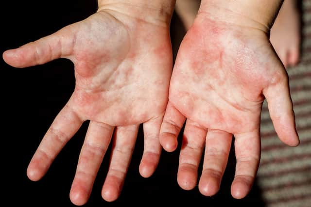 Symptoms of scarlet fever include a sandpapery skin rash