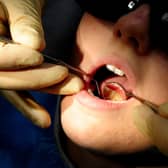 There were 100 hospital admissions to remove children's decaying teeth last year