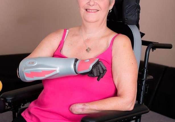 The prosthetic hands are  too cumbersome and of limited use, says Kim