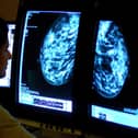 More women in MK are undergoing breast cancer screening