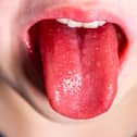 'Strawberry tongue' is a classic symptom of a child with scarlet fever