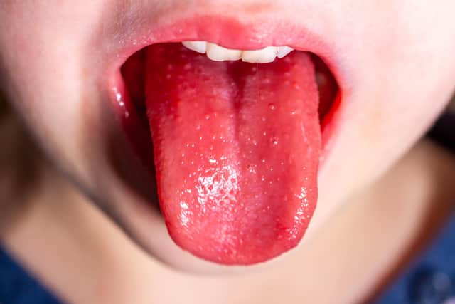 'Strawberry tongue' is a classic symptom of a child with scarlet fever