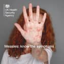 A national incident has been declared over the rapid rise in measles cases