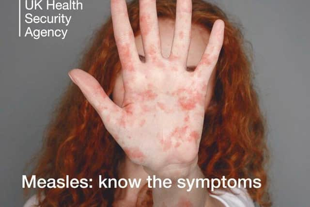 A national incident has been declared over the rapid rise in measles cases