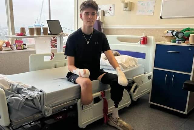 Hamish Wilson, 18, has lost both legs and hands to sepsis