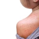 A child has died in a UK hospital from measles. Photo: stock.adobe.com