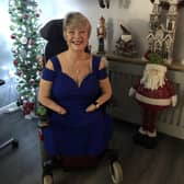 Kim Smith is awaiting a human hand transplant