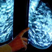 The number of women opting for a routine breast screening mammogram is below that of the pandemic