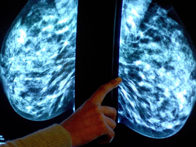 The number of women opting for a routine breast screening mammogram is below that of the pandemic
