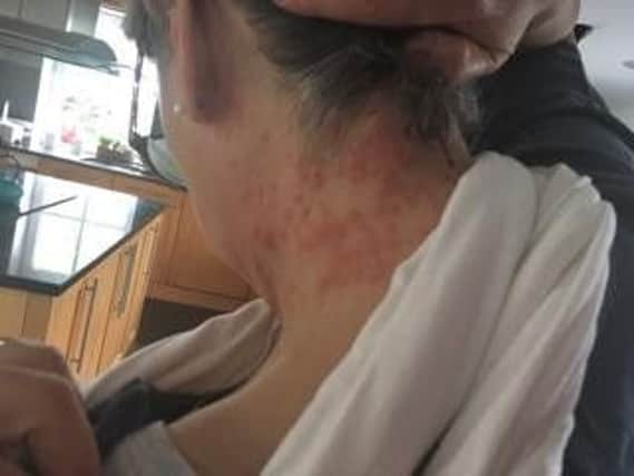 Rash caused by the caterpillars