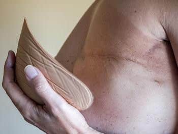 Mastectomy editorial image